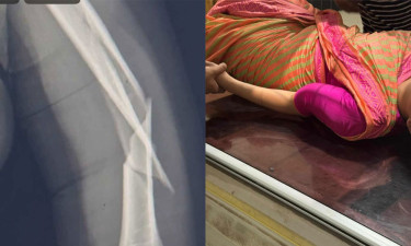 মাঝ আকাশে বিমানের ফ্লাইটে ঝাঁকুনি, পড়ে হাত ভাঙল কেবিন ক্রুর