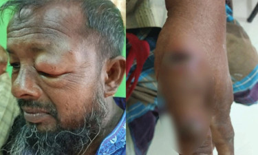 গাইবান্ধায় ১১ জনের শরীরে অ্যানথ্রাক্সের উপসর্গ, সতর্কতা জারি