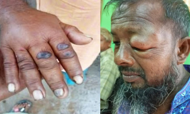 গাইবান্ধায় ১১ জনের শরীরে অ্যানথ্রাক্সের উপসর্গ শনাক্ত