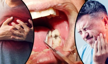 দাঁতের সঙ্গে জড়িয়ে থাকতে পারে স্ট্রোকের ঝুঁকি